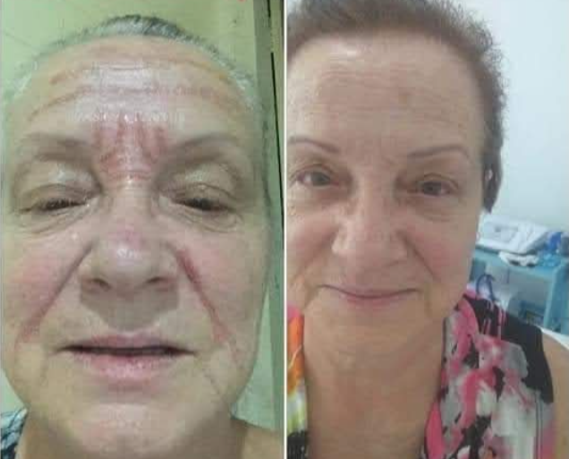 Antes e depois de Tratamento Facial